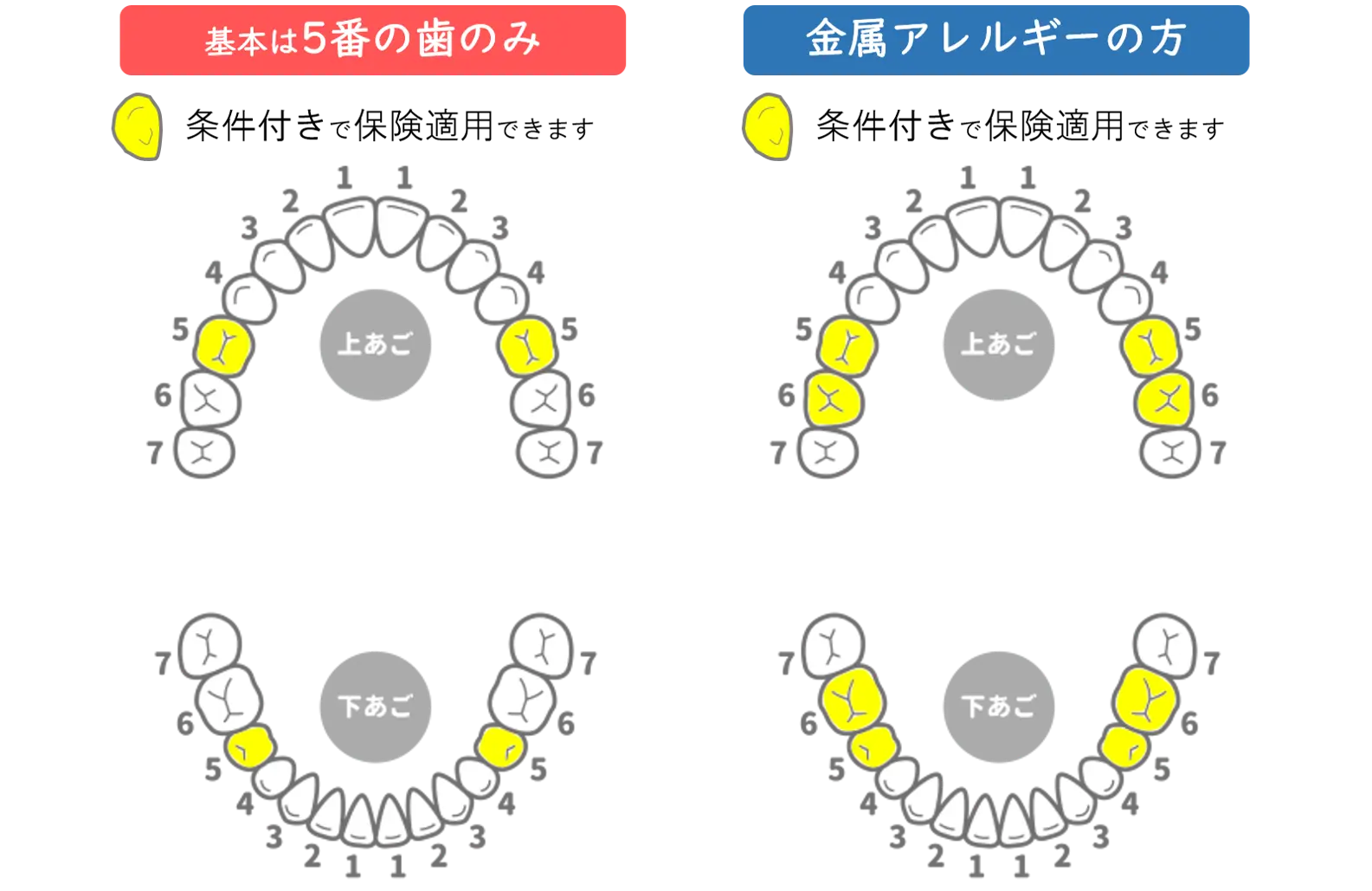 久里浜の歯医者、久里浜グリーン歯科の保険適用の白い歯